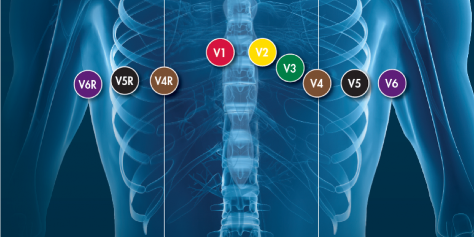 Colocação de eletrodos de ECG multi derivação - Indumed